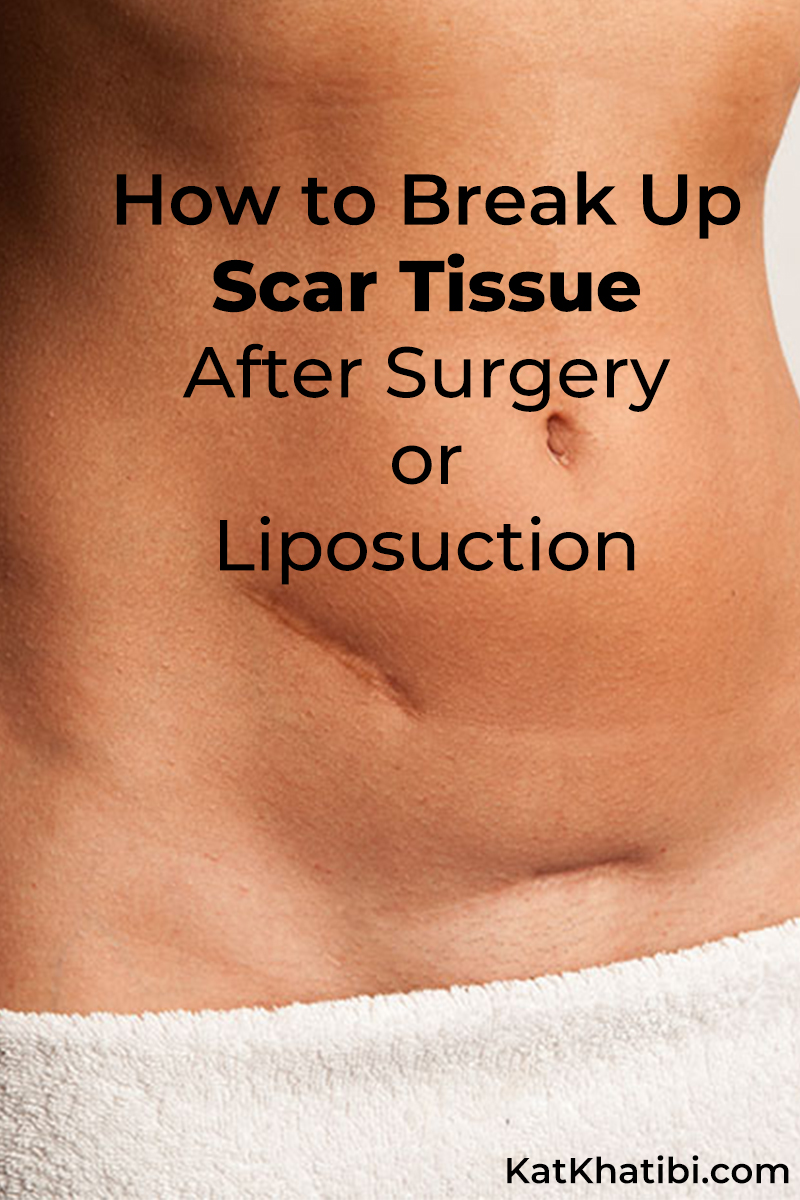 Liposuction Scars On Stomach