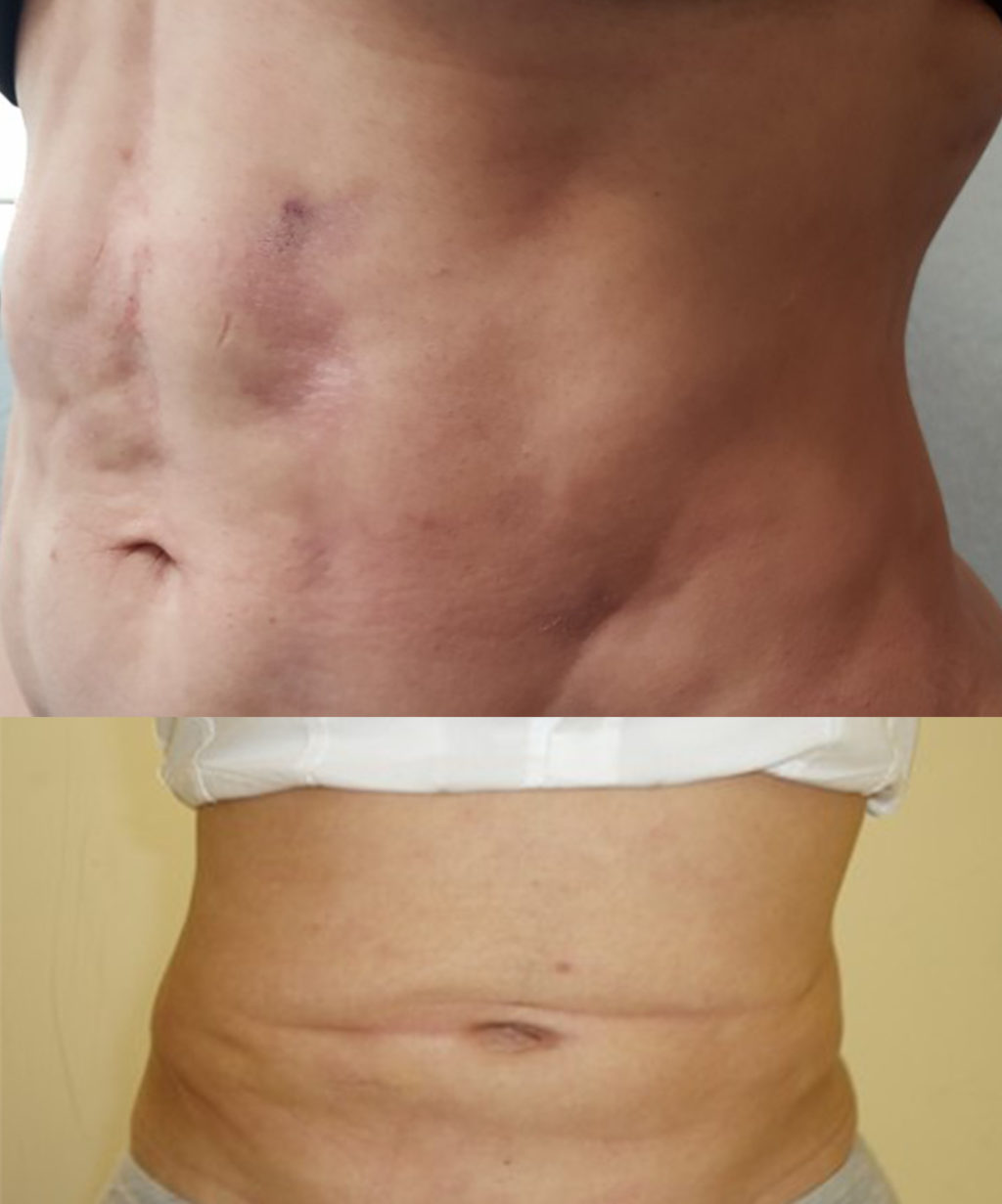 How to Break Up Scar Tissue After Surgery Or Liposuction | Fibrosis